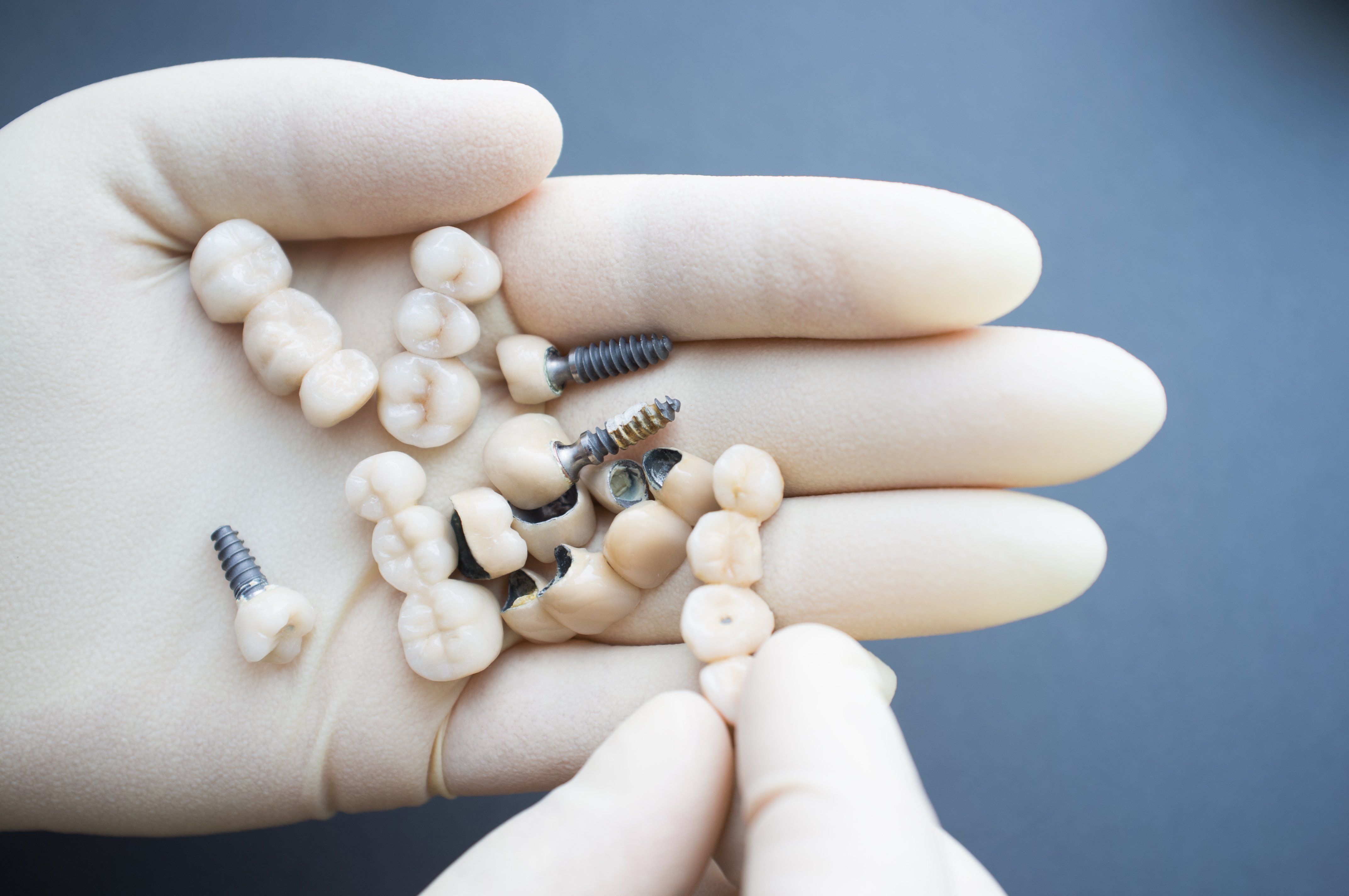 How long do Dental Crowns last?