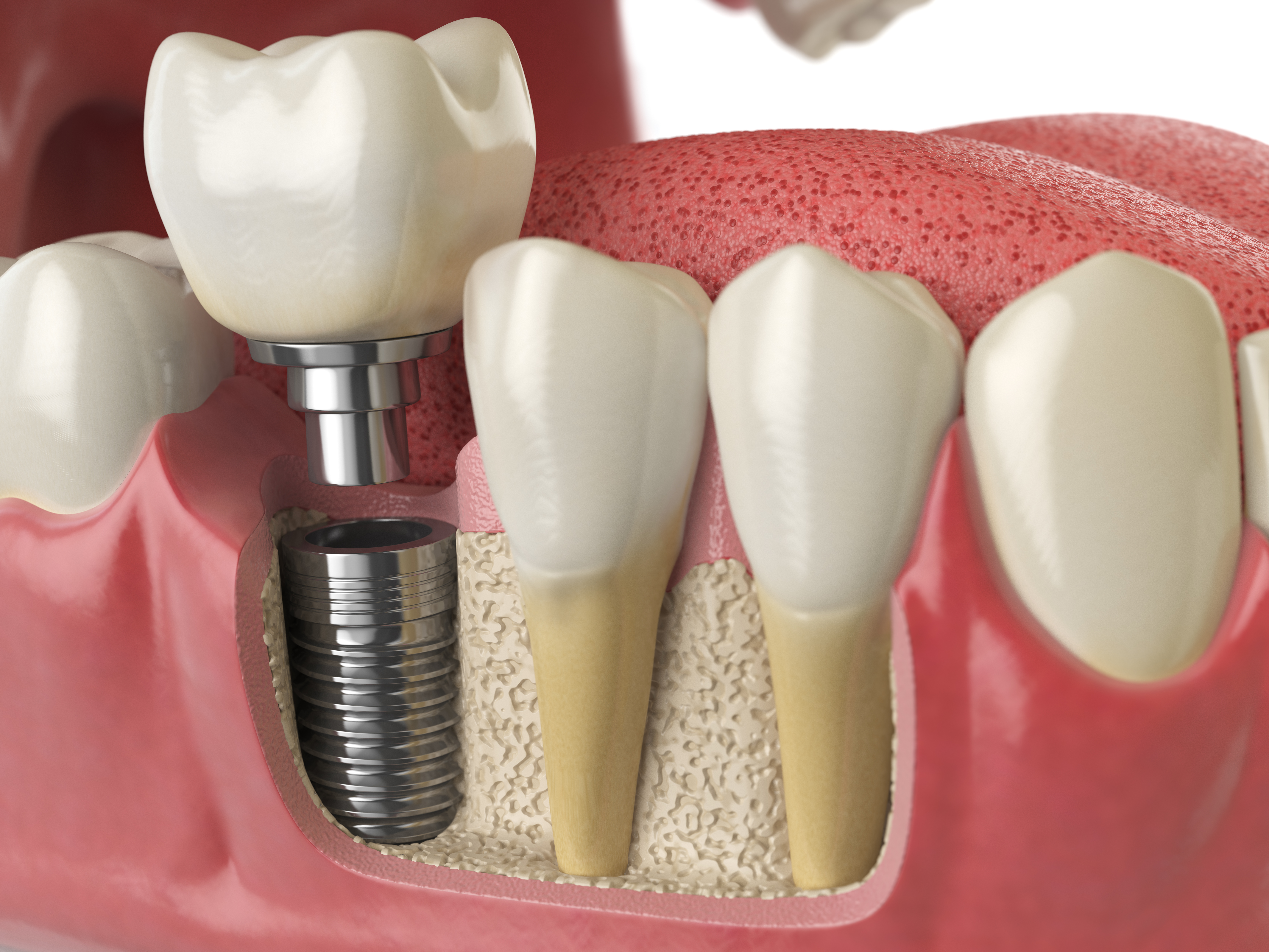 What are Dental Implants?